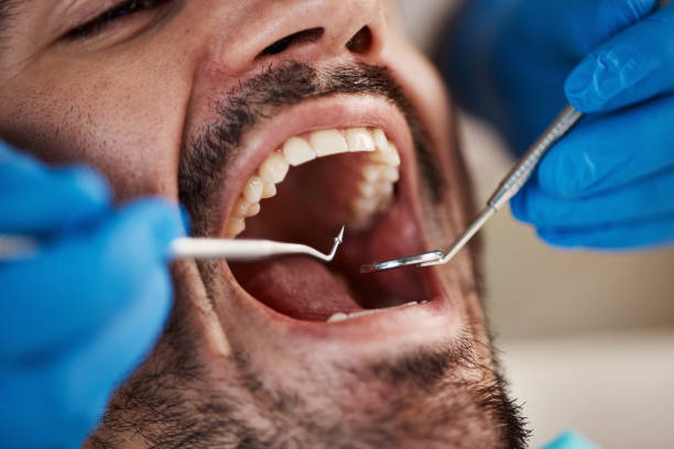 Best Emergency Dentist for Lost Fillings or Crowns in Han, GA